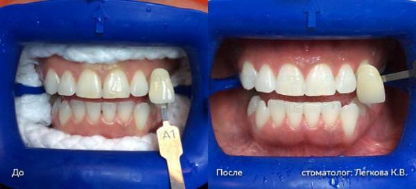 пример выполненной процедуры отбеливания зубов ZOOM 4