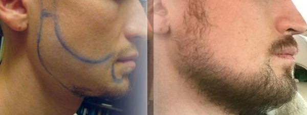 пересадка волос бороды